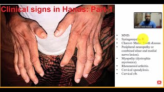 Clinical signs in hand Part1 [upl. by Dewhirst]