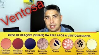 Ventosa Mini Curso de Ventosaterapia  Parte 22 [upl. by Cheadle]