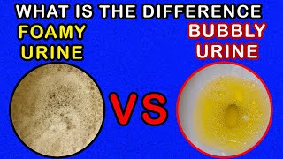 Differences between Foamy Urine Vs Bubbly Urine [upl. by Initof184]