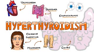 Hyperthyroidism Signs and Symptoms Mnemonic  SWEATING [upl. by Edaw139]