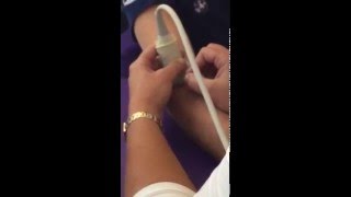 Ultrasound guided dry needling of the supinator muscle [upl. by Tteve]