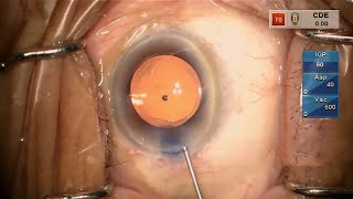 Corneal Endothelial Avulsion During Cataract Surgery [upl. by Eenahs]