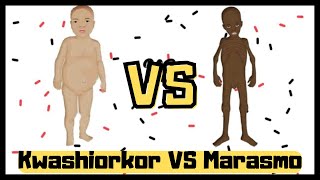 Marasmo  Kwashiorkor diferencias [upl. by Esorbma]