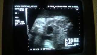 CYST with echogenic area in FETAL lower abdomen [upl. by Nywroc]