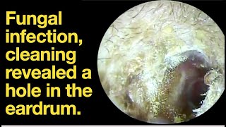 Fungal infection cleaning revealed a hole in the eardrumear wax removal  ear cleaning  ASMR [upl. by Jourdan]