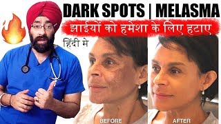 Permanently Cure DARK SPOTS झाइयां MELASMA HYPERPIGMENTATION or BLACK MARKS ENG SUBTITLES [upl. by Nickey631]