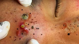 🤮puntos negro en la nariz extracción🔞🤢Black head [upl. by Haret735]