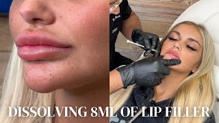 Dissolving 8ml of Lip Filler Insane Results [upl. by Farr]