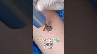 하찮은 스펀지밥 지ㅂ 아니 파인애플 문신제거 Laser Tattoo Removal [upl. by Abigail471]