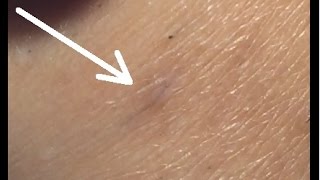 Electrolysis on Ingrown Hairs Step by Step [upl. by Stauffer]