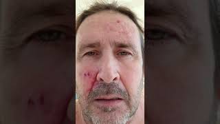 skin cancer video 6 round 2 1 year later fluorocil efudex 5 chemotherapy cream [upl. by Berkman]