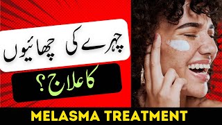 Melasma Treatment  Chaiyon Ka Ilaj  How to Fade Dark spots on skinamp face after pregnancy [upl. by Llenej]