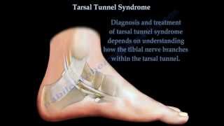 Tarsal Tunnel Syndrome  Everything You Need To Know  Dr Nabil Ebraheim [upl. by Itin]