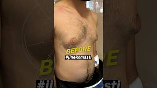 Gynecomasty Surgery BeforeAfter gynecomastiaresult [upl. by Pigeon605]