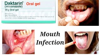 Daktarin Gel  Daktarin Orale Gel How To Use  Daktarin Oral Gel Side Effects [upl. by Ki]