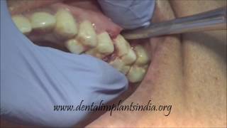 How to use luxator and forceps to remove upper decayed first molar [upl. by Aubigny813]