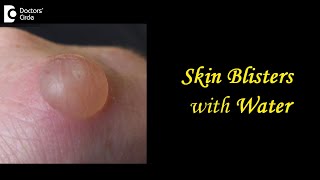 Skin Blisters with Water Causes Treatment Draining Prevention  DrAruna Prasad  Doctors Circle [upl. by Deckert]