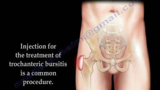 Trochanteric Bursitis Injection  Everything You Need To Know  Dr Nabil Ebraheim [upl. by Harima149]