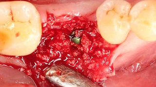 Clinical application of OSTEON™ lll Dentium alloplastic graft [upl. by Ocirrej]