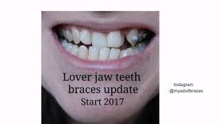 Lower braces 2 years progress [upl. by Fergus]