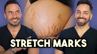 Major Announcement  How to Treat Stretch Marks like a Dermatologist [upl. by Calder]