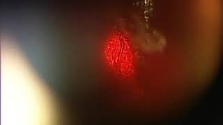 Eye Floater Laser Vitreolysis Patient of Scott Geller MD [upl. by Han695]