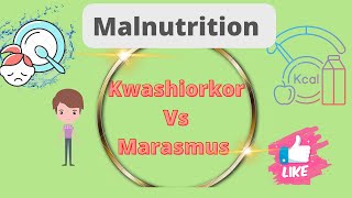 Kwashiorkor vs Marasmus DefinationDifference Malnutrition Nursing notes [upl. by Mak]