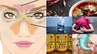 How to Cure Sinus Infection or Sinusitis by 5 Simple Home Remedies [upl. by Nahsaj]