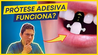 PRÓTESE DENTÁRIA ADESIVA FUNCIONA MESMO QUANTO TEMPO DURA [upl. by Tsew]