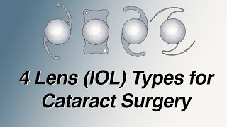 4 Main Lens IOL Types for Cataract Surgery Pros and Cons Basic Version [upl. by Artur]