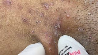 Relax Every Day Blackheads on the neck SacDepSpa483 [upl. by Reerg]