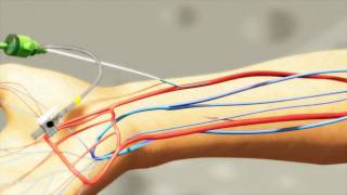 Radial artery puncture using the Insyte and Angiocath technique [upl. by Atnomed406]