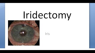 Ophthalmology Iridectomy Indications Procedure Surgical Iridotomy Difference [upl. by Atnad741]