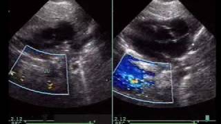 Total Anomalous Pulmonary Venous ConnectionTAPVC [upl. by Sualohcin621]