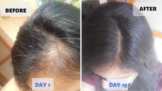 OMG  15 Days Hair Growth Miracle Treatment  Grow Long Thicken Hair  100 works [upl. by Ahsille]