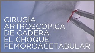 Cirugía artroscópica de cadera el choque femoroacetabular por el Dr Ángel Villamor [upl. by Eberta]