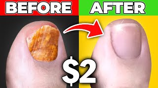 Get Rid Of Toenail Fungus for Good Dr Bergs 200 Cure [upl. by Anirual]