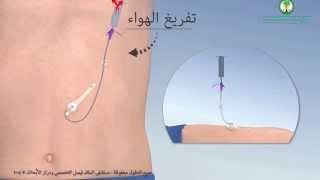 Gastrostomy Feeding Tube أنبوب التغذية ميكي عبر جدار البطن [upl. by Lianne]