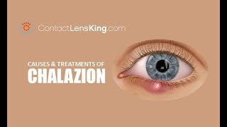 Chalazion  Causes Treatment and Surgery [upl. by Atkins]