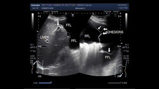 Ultrasound Video showing multiple adhesions in between the gut loops [upl. by Badr]