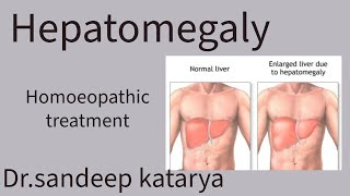 hepatomegaly gallbladderhealth  gallbladder stonehomeopathic sour alcoholabuse [upl. by Perry]