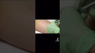 Removing birth control implant [upl. by Bilski]