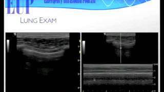 UltrasoundPodcastcom  Ultrasound for Dyspnea [upl. by Tess]