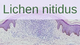 Lichen Nitidus  Pathology mini tutorials [upl. by Urata519]