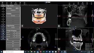 3rd Molar Extraction with AIS 3D App 50 [upl. by Talmud]