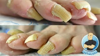 LONG TOENAILS FOR DAYS  TOENAIL CUTTING PART 1 [upl. by Aidroc]