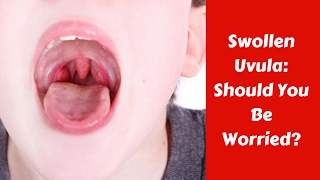 Swollen Uvula  Should you be worried [upl. by Sarson]