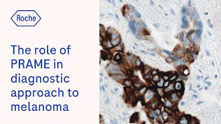 The role of PRAME immunohistochemistry in the diagnostic approach to melanocytic lesions [upl. by Elletnuahc]