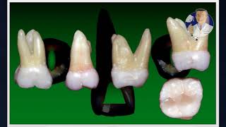 Módulo I  Aula 3 Cirurgia de Acesso  Molares Superiores [upl. by Isola]
