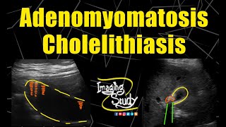 Adenomyomatosis amp Cholelithiasis  Ultrasound  Case 183 [upl. by Abihsot]